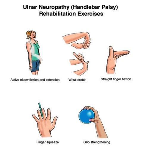 Exclusive Physiotherapy Guide For Physiotherapists Exercise For Ulnar