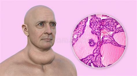 A Man With Enlarged Thyroid Gland 3d Illustration And Micrograph