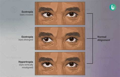 Cross Eyes Symptoms Causes Treatment Medicine Prevention Diagnosis