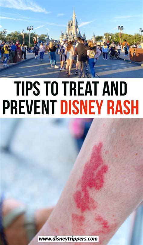 How To Treat And Prevent Disney Rash Tips For Treating And Preventing