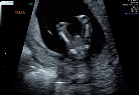 13 Week Ultrasound Pics Please Confirm Gender