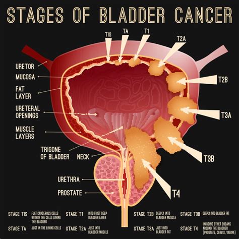 And if turns out aging bladder muscles are the only reason for these symptoms, a urologist can recommend exercises or the same is true for people of color, male or female. Smoking Promotes Bladder Cancer - DrCarney.com Blog ...