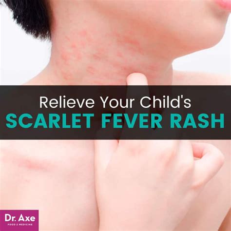 Dont Ignore These Scarlet Fever Warning Signs In 2021 Scarlet Fever