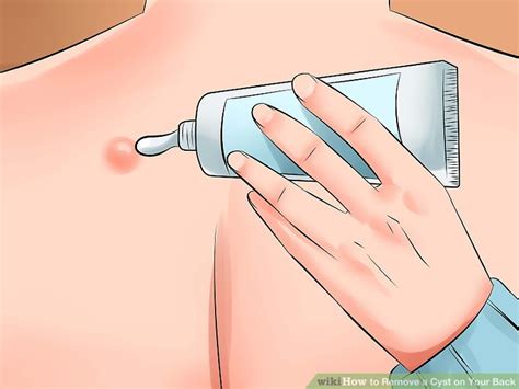 3 Ways To Remove A Cyst On Your Back WikiHow