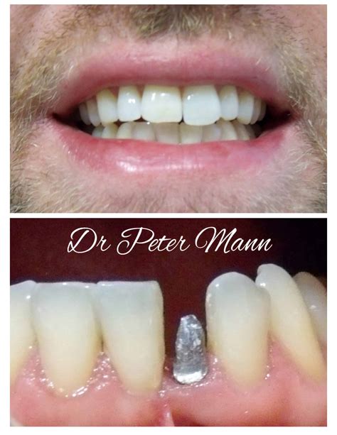 Mini Dental Implants Before And After Gallery Manhattan
