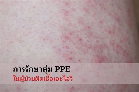 การรักษาตุ่ม Ppe ในผู้ป่วยติดเชื้อเอชไอวี Thaihiv365