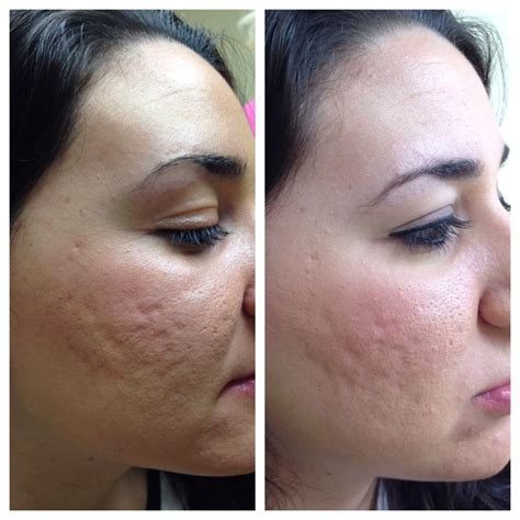 Microneedling Before And After Prp Before And After