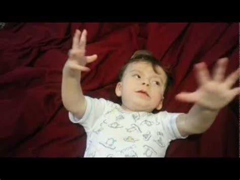 These disorders are characterized by craniofacial and limb abnormalities. Pallister-killian Syndrome