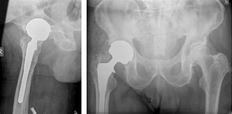 Anteroposterior Ap And Lateral Radiograph Of The Right Hip Showing A