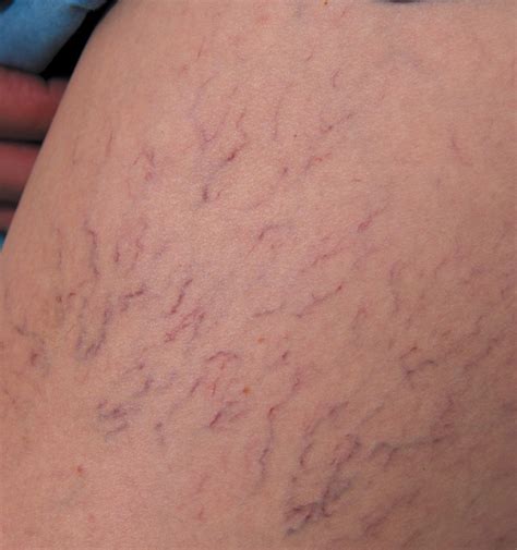 Varicose Veins A Symptom Of Serious Health Issues The