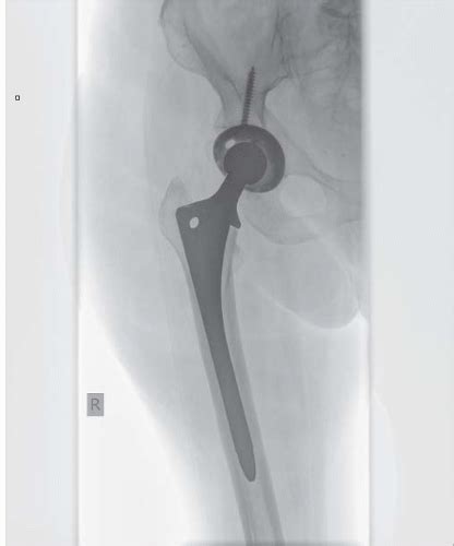 Femoral Neck Fractures: Hemiarthroplasty and Total Hip ...