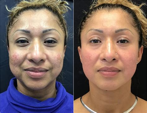 Melanage Peel Before And After Fairfax And Washington Dc