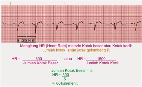 Interpretasi EKG Langkah