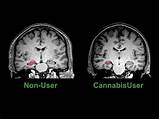How Does Marijuana Affect Your Brain Cells Photos