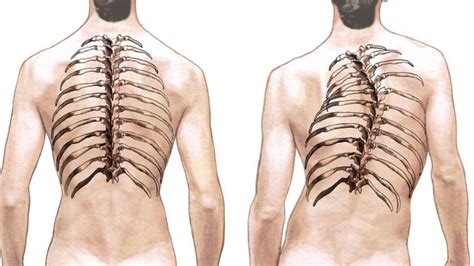 Spinal Curvature And Deformity Scoliosis Kyphosis And Lordosis
