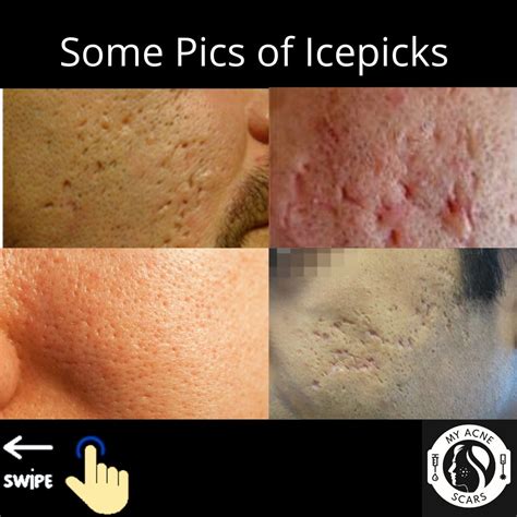 Icepick Acne Scars A Overview My Acne Scars
