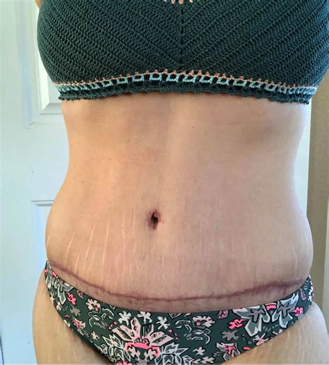 Tummy Tuck 5 Weeks Post Op Cosmetic Surgery Tips