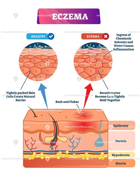 Eczema Biological Vector Illustration Skin Layer Diagram Crochet Ripple