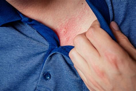 Dermatite da stress cos è cause sintomi rimedi e cura prevenzione