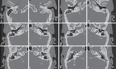 Exergen Temporal Scan Clearance Deals Save 62 Jlcatjgobmx