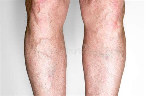 Varicose Veins On Leg Stock Photo Image Of Healthcare 141152360