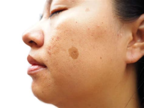 Skin Tone Discolored Skin Freckles