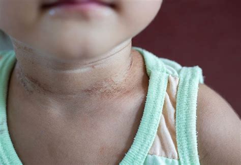 Rashes On Babys Neck Reasons And Treatment