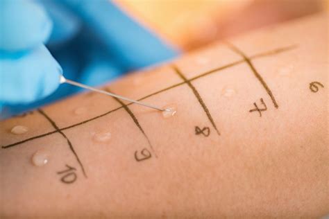 Why Skin Testing Is The Best Form Of Allergy Testing Regional Allergy