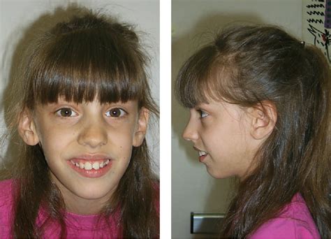 Mental Retardation Similar Facial Features Girls Telegraph