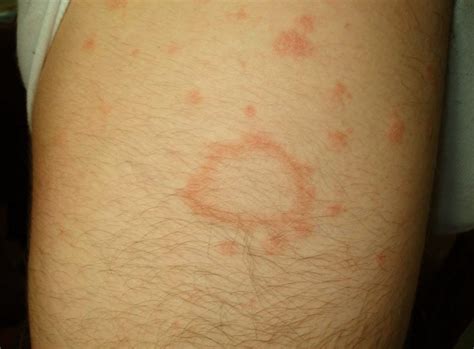 Pityriasis Rosea Pictures