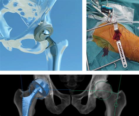 Hip Surgery Ortoma