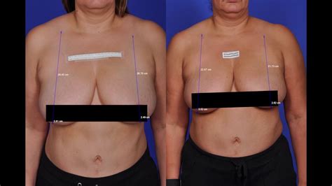 THERMIBREAST GIVES WOMEN A LIFT YouTube