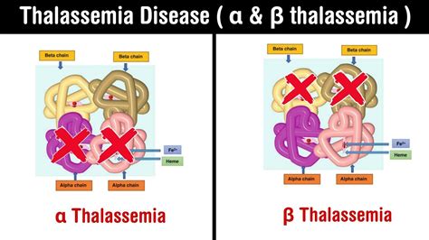 Thalassemia Symptoms And Treatment Alpha Thalassemia Beta