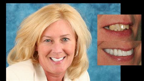 Smile Makeover With Porcelain Bridges Cosmetic Dentistry By Dr Mike Maroon Of Advanced Dental