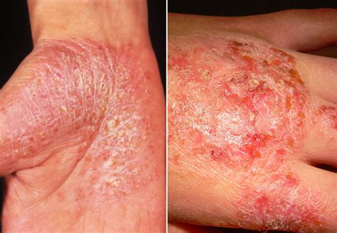 Systematic Review Of Eczema In Plaque Psoriasis Treated With Biologic