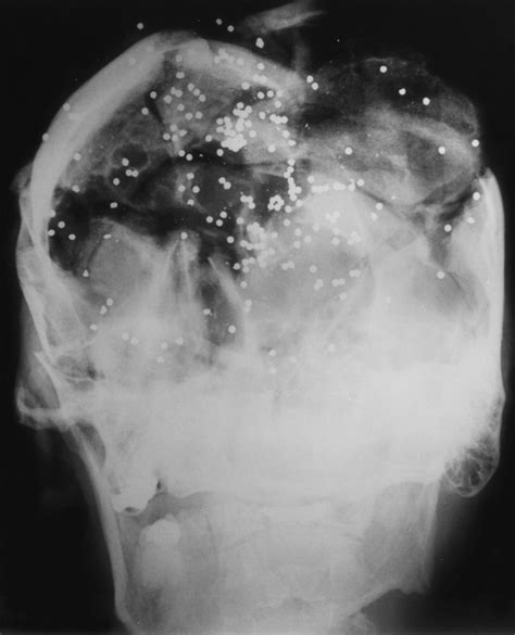 Gunshot Injuries What Does A Radiologist Need To Know Radiographics