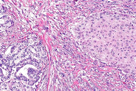 Sarcomatoid Carcinoma Of The Lung Pathophysiology Wikidoc