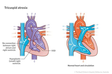 Cardiology Tricuspid Atresia Pediatric Heart Tetralogy Heart Defect