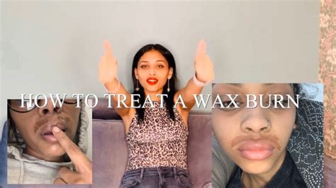 How To Treat A Wax Burndoes It Scar Youtube
