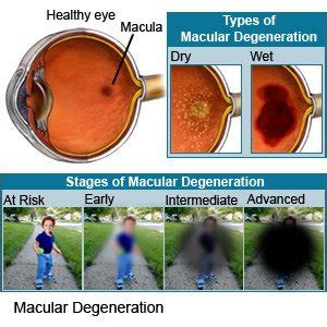Macular Degeneration What You Need To Know