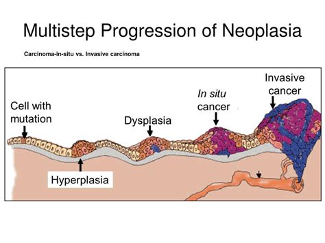 Ppt Multistep Progression Of Neoplasia Powerpoint Presentation Free