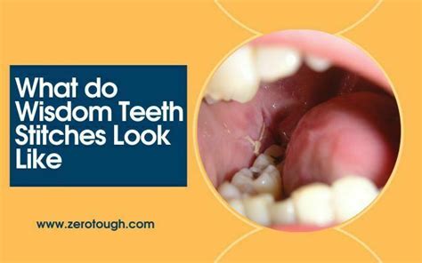 What Do Wisdom Teeth Stitches Look Like Detail Zero Tough