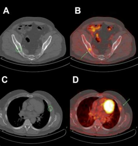 Panel Of 18 F Fdg Pet Ct Imaging At 6 Months Follow Up Of Patient 7