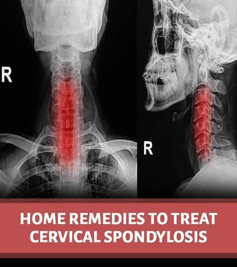 Cervical Spondylosis Symptoms Causes Natural Treatments Exercises