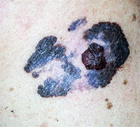 Melanoma Symptoms Signs Of Melanoma Melanoma Skin Dermatim