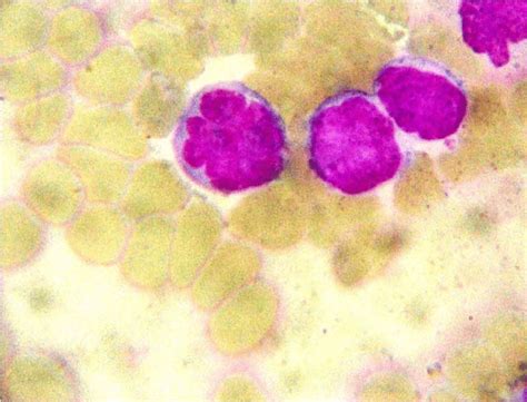 Peripheral Smear Showing Cells With Flower Like Nuclei In Adult T Cell