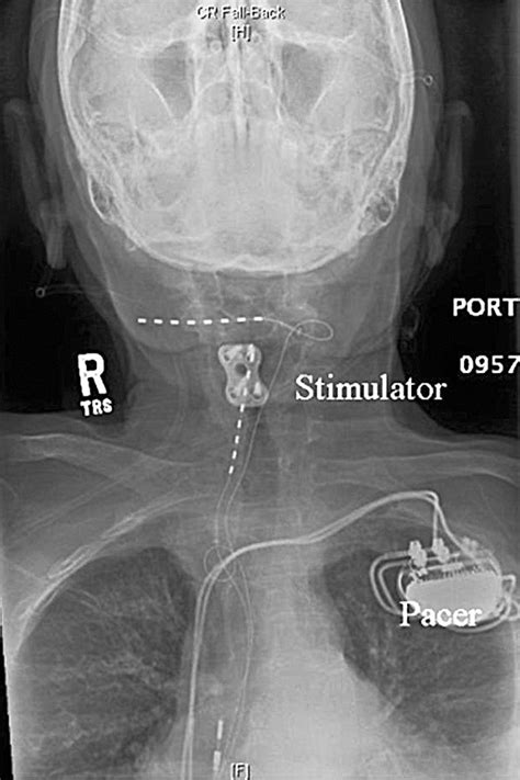 Successful Treatment Of Occipital Neuralgia With Implantable Peripheral