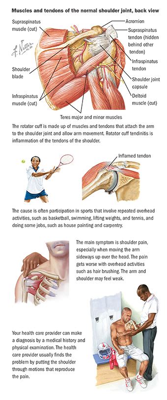 Rupture of the supraspinatus tendon. About Shoulder Tendonitis | Orthopedic Health | Spectrum Health