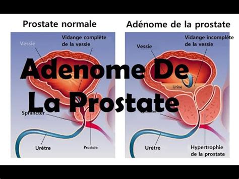 Soins en Uro Néphrologie Cours S4 Episode 07 Adenome De La Prostate