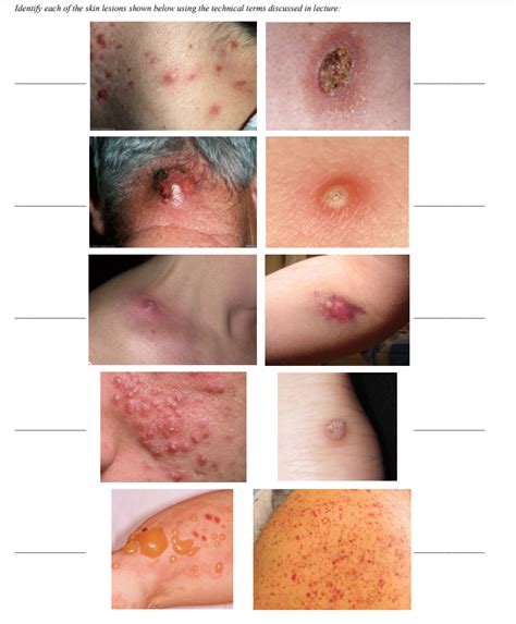 Identify Each Of The Skin Lesions Shown Below Using